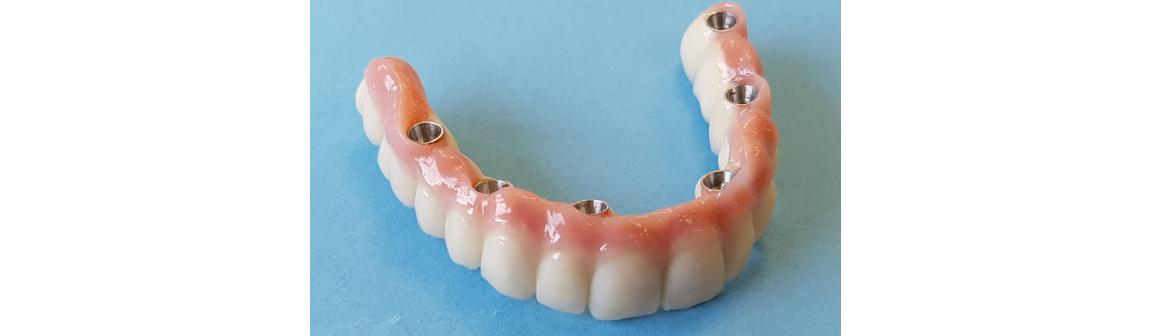 Zahnersatz, Dentallabor Wohlfart & Herkel GmbH