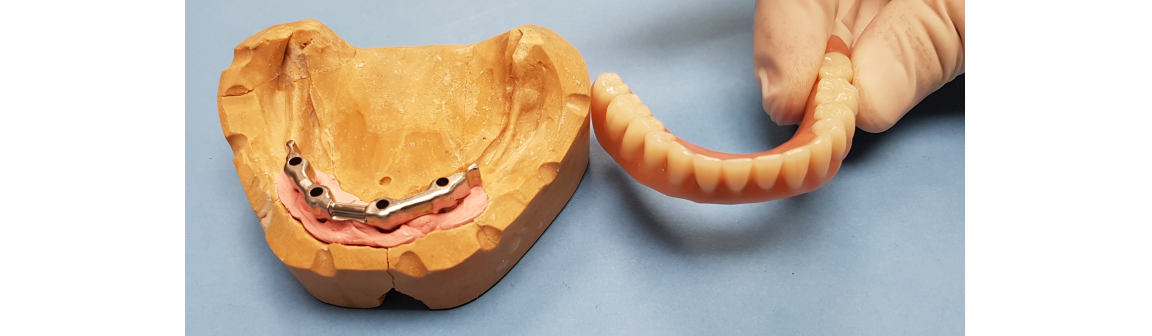 Zahnersatz, Dentallabor Wohlfart & Herkel GmbH