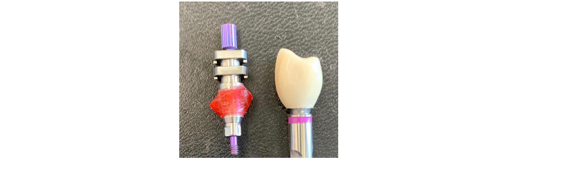 Zahnersatz, Dentallabor Wohlfart & Herkel GmbH