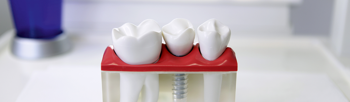 Zahnersatz, Zahntechnisches Meisterlabor Meyer Dental